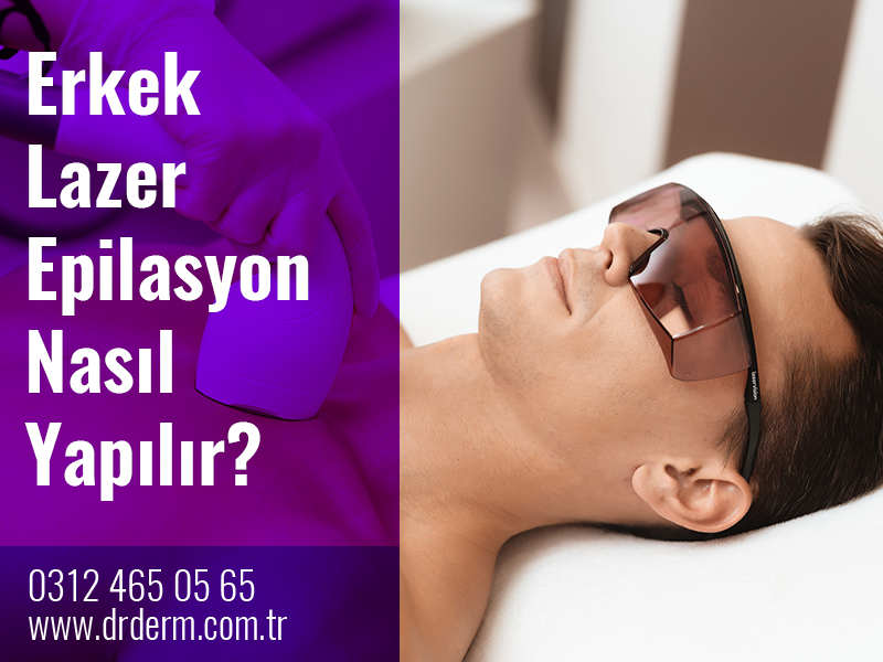 Erkek Lazer Epilasyon Nasıl Yapılır?