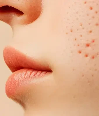 Ankara akne ve sivilce tedavisi IDÔLET Beauty