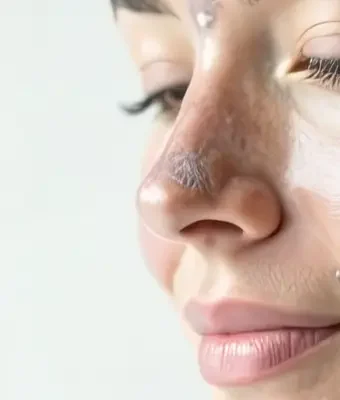 Ankara cilt leke tedavisi protokolü IDÔLET Beauty