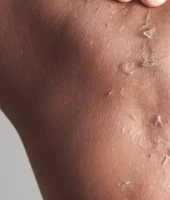 Ankara skar ve akne izi tedavisi IDÔLET Beauty